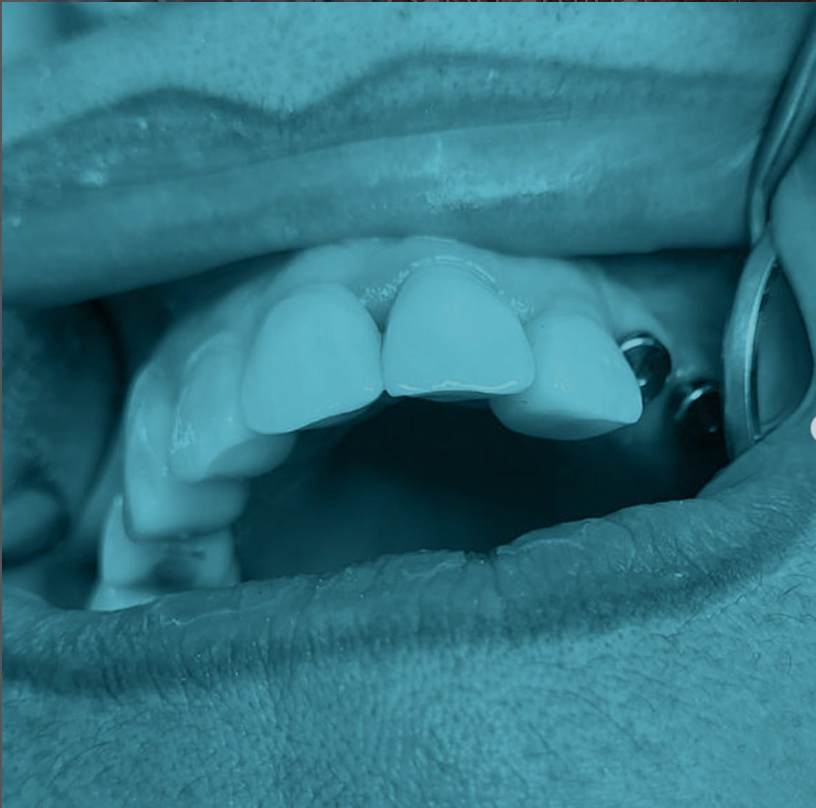 Estética dental en Bio Salud Dental Madrid